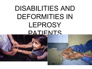 DISABILITIES AND
DEFORMITIES IN
LEPROSY
PATIENTS
 