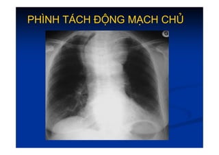Ph
Ph×
×nh t¸ch ®éng m¹ch chñ
nh t¸ch ®éng m¹ch chñ
 