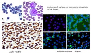 lymphoma cells are large and pleomorphic with variable
nuclear shapes
LANA 1 POSITIVE IMMUNOFLUROSCENT STAINING
 