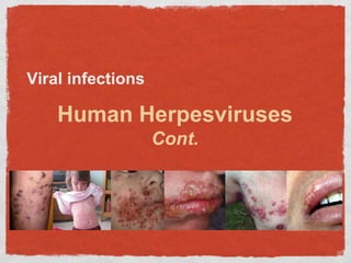 Viral infections
Human Herpesviruses
Cont.
 