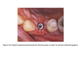 Figure 10: Implant exposed positioning the flap buccally in order to achieve attached gingiva.
 