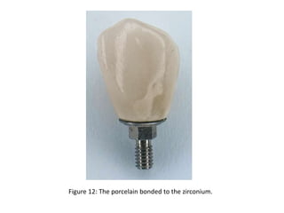Figure 12: The porcelain bonded to the zirconium.
 