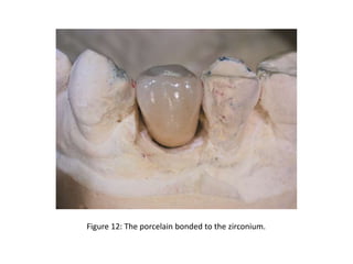 Figure 12: The porcelain bonded to the zirconium.
 