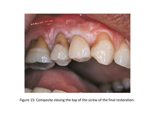 Figure 15: Composite closing the top of the screw of the final restoration.
 