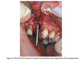 Figure 4: The final drill used to evaluate the position and angulation of the preparation.
 