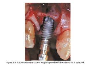 Figure 5: A 4.20mm diameter 13mm length Tapered Self Thread Implant is selected.
 