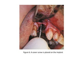 Figure 6: A cover screw is placed on the implant
 