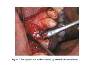 Figure 7: The implant and socket covered by a resorbable membrane.
 
