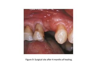 Figure 9: Surgical site after 4 months of healing.
 