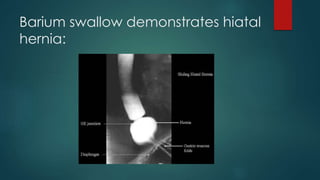 Barium swallow demonstrates hiatal
hernia:
 