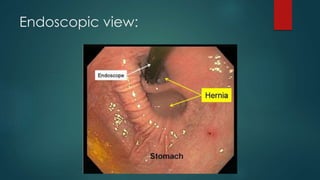Endoscopic view:
 