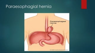 Paraesophagial hernia
 