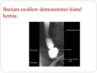 Barium swallow demonstrates hiatal
hernia:
 