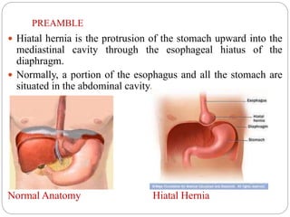 PREAMBLE
 Hiatal hernia is the protrusion of the stomach upward into the
mediastinal cavity through the esophageal hiatus of the
diaphragm.
 Normally, a portion of the esophagus and all the stomach are
situated in the abdominal cavity.
Normal Anatomy Hiatal Hernia
 