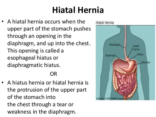 Hiatal hernia Hiatal hernia