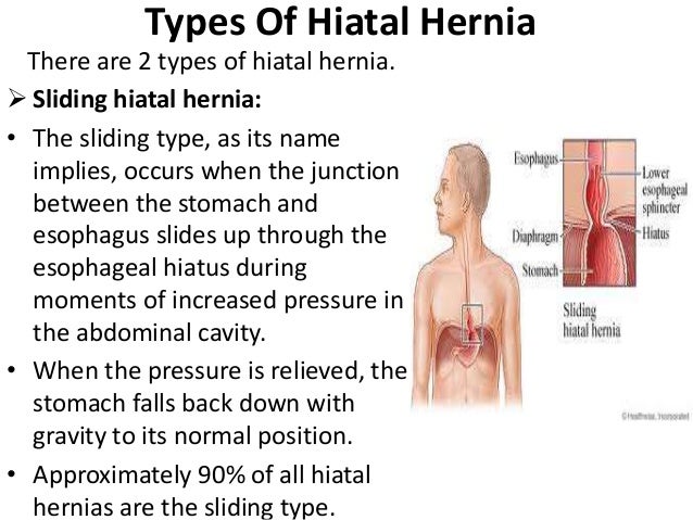 Hiatal Hernia Size Chart