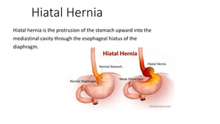 Hiatal Hernia
Hiatal hernia is the protrusion of the stomach upward into the
mediastinal cavity through the esophageal hiatus of the
diaphragm.
 