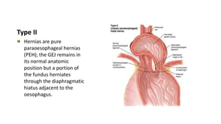 Type II
Hernias are pure
paraoesophageal hernias
(PEH); the GEJ remains in
its normal anatomic
position but a portion of
the fundus herniates
through the diaphragmatic
hiatus adjacent to the
oesophagus.
 