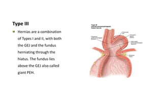 Type III
Hernias are a combination
of Types I and II, with both
the GEJ and the fundus
herniating through the
hiatus. The fundus lies
above the GEJ also called
giant PEH.
 