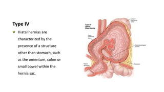 Type IV
Hiatal hernias are
characterized by the
presence of a structure
other than stomach, such
as the omentum, colon or
small bowel within the
hernia sac.
 