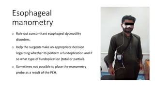 Esophageal
manometry
o Rule out concomitant esophageal dysmotility
disorders.
o Help the surgeon make an appropriate decision
regarding whether to perform a fundoplication and if
so what type of fundoplication (total or partial).
o Sometimes not possible to place the manometry
probe as a result of the PEH.
 