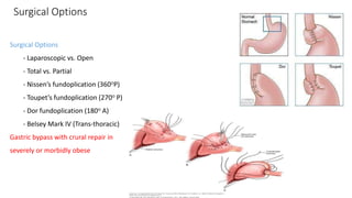 Surgical Options
Surgical Options
- Laparoscopic vs. Open
- Total vs. Partial
- Nissen’s fundoplication (360○P)
- Toupet’s fundoplication (270○ P)
- Dor fundoplication (180○ A)
- Belsey Mark IV (Trans-thoracic)
Gastric bypass with crural repair in
severely or morbidly obese
 