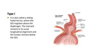 Type I
It is also called a sliding
hiatal hernia, where the
GEJ migrates above the
diaphragm. The stomach
remains in its usual
longitudinal alignment and
the fundus remains below
the GEJ.
 