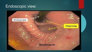 Endoscopic view:
 