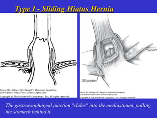 Type I - Sliding Hiatus HerniaType I - Sliding Hiatus Hernia
The gastroesophageal junction "slides" into the mediastinum, pulling
the stomach behind it.
 