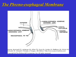 The Phreno-esophageal MembraneThe Phreno-esophageal Membrane
 