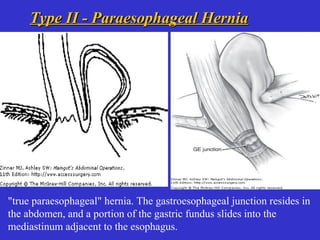 Type II - Paraesophageal HerniaType II - Paraesophageal Hernia
"true paraesophageal" hernia. The gastroesophageal junction resides in
the abdomen, and a portion of the gastric fundus slides into the
mediastinum adjacent to the esophagus.
 
