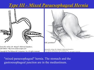 Type III - Mixed Paraesophageal HerniaType III - Mixed Paraesophageal Hernia
"mixed paraesophageal" hernia. The stomach and the
gastroesophageal junction are in the mediastinum.
 