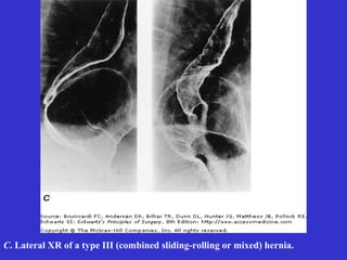 C. Lateral XR of a type III (combined sliding-rolling or mixed) hernia.
 