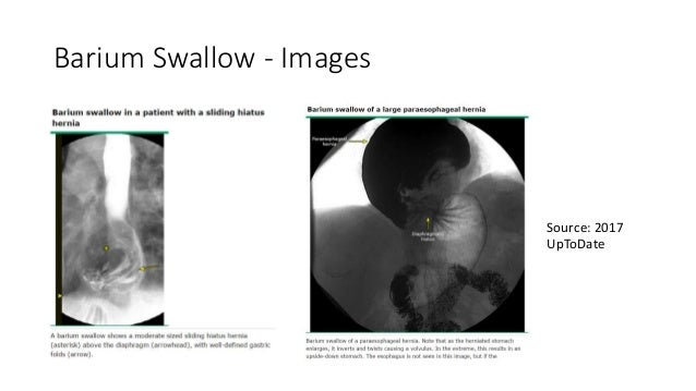 Hiatal hernias normal swallow diagram 