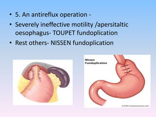 • 5. An antireflux operation -
• Severely ineffective motility /apersitaltic
oesophagus- TOUPET fundoplication
• Rest others- NISSEN fundoplication
 