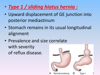 • Type 1 / sliding hiatus hernia :
• Upward displacement of GE junction into
posterior mediastinum
• Stomach remains in its usual longitudinal
alignment
• Prevalence and size correlate
with severity
of reflux disease.
 