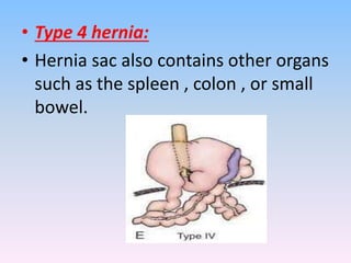 • Type 4 hernia:
• Hernia sac also contains other organs
such as the spleen , colon , or small
bowel.
 