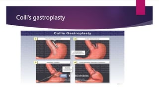 hiatus hernia.pptxmmmmmmmmmmmmmmmmmmmmmmm. | PPTX