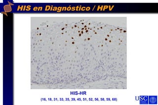 HIS en Diagnóstico / HPV
HIS-HR
(16, 18, 31, 33, 35, 39, 45, 51, 52, 56, 58, 59, 68)
 