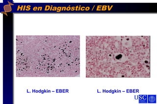 HIS en Diagnóstico / EBV
L. Hodgkin – EBER L. Hodgkin – EBER
 