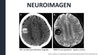 NEUROIMAGEN
TAC: sensible para identificar sangrado RMN T2 y eco gradiente: agudo y cronico
Nancy J. Fischbeina, et al. Nontraumatic Intracranial Hemorrhage. Neuroimag Clin N Am 20 (2010) 469–492
 