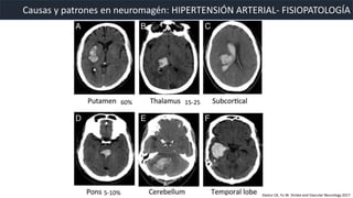 Causas y patrones en neuromagén: HIPERTENSIÓN ARTERIAL- FISIOPATOLOGÍA
60% 15-25
5-10% Dastur CK, Yu W. Stroke and Vascular Neurology 2017
 