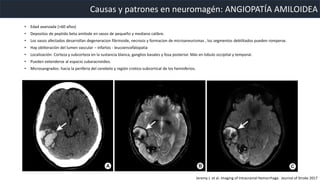 Causas y patrones en neuromagén: ANGIOPATÍA AMILOIDEA
• Edad avanzada (>60 años)
• Depositos de peptido beta amilode en vasos de pequeño y mediano calibre.
• Los vasos afectados desarrollan degeneracion fibrinoide, necrosis y formacion de microaneurismas , los segmentos debilitados pueden romperse.
• Hay obliteración del lumen vascular – infartos - leucoencefalopatia
• Localización: Corteza y subcorteza en la sustancia blanca, ganglios basales y fosa posterior. Más en lobulo occipital y temporal.
• Pueden extenderse al espacio subaracnoideo.
• Microsangrados: hacia la periferia del cerebelo y región crotico-subcortical de los hemisferios.
Jeremy J. et al. Imaging of Intracranial Hemorrhage. Journal of Stroke 2017
 