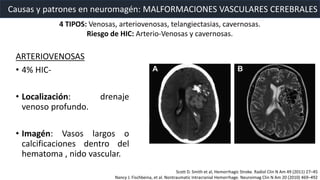 Causas y patrones en neuromagén: MALFORMACIONES VASCULARES CEREBRALES
ARTERIOVENOSAS
• 4% HIC-
• Localización: drenaje
venoso profundo.
• Imagén: Vasos largos o
calcificaciones dentro del
hematoma , nido vascular.
4 TIPOS: Venosas, arteriovenosas, telangiectasias, cavernosas.
Riesgo de HIC: Arterio-Venosas y cavernosas.
Scott D. Smith et al, Hemorrhagic Stroke. Radiol Clin N Am 49 (2011) 27–45
Nancy J. Fischbeina, et al. Nontraumatic Intracranial Hemorrhage. Neuroimag Clin N Am 20 (2010) 469–492
 