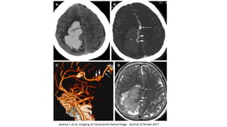 Jeremy J. et al. Imaging of Intracranial Hemorrhage. Journal of Stroke 2017
 