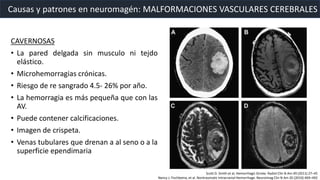 Causas y patrones en neuromagén: MALFORMACIONES VASCULARES CEREBRALES
CAVERNOSAS
• La pared delgada sin musculo ni tejdo
elástico.
• Microhemorragias crónicas.
• Riesgo de re sangrado 4.5- 26% por año.
• La hemorragia es más pequeña que con las
AV.
• Puede contener calcificaciones.
• Imagen de crispeta.
• Venas tubulares que drenan a al seno o a la
superficie ependimaria
Scott D. Smith et al, Hemorrhagic Stroke. Radiol Clin N Am 49 (2011) 27–45
Nancy J. Fischbeina, et al. Nontraumatic Intracranial Hemorrhage. Neuroimag Clin N Am 20 (2010) 469–492
 