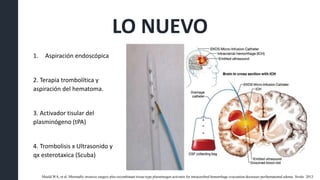 LO NUEVO
1. Aspiración endoscópica
2. Terapia trombolítica y
aspiración del hematoma.
3. Activador tisular del
plasminógeno (tPA)
4. Trombolisis x Ultrasonido y
qx esterotaxica (Scuba)
Mould WA, et al. Minimally invasive surgery plus recombinant tissue-type plasminogen activator for intracerebral hemorrhage evacuation decreases perihematomal edema. Stroke 2013.
 