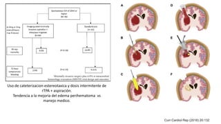 Minimally invasive surgery plus rt-PA in intracerebral
hemorrhage evacuation (MISTIE) trial design and outcomes
Curr Cardiol Rep (2018) 20:132
Uso de cateterizacion estereotaxica y dosis intermitente de
rTPA + aspiración.
Tendencia a la mejoria del edema perihematoma vs
manejo medico.
 