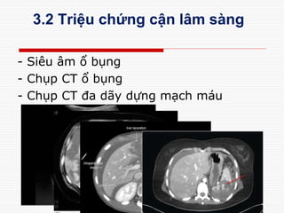 3.2 Triệu chứng cận lâm sàng
- Siêu âm ổ bụng
- Chụp CT ổ bụng
- Chụp CT đa dãy dựng mạch máu
 