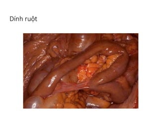 Hội chứng tắc ruột | PPSX